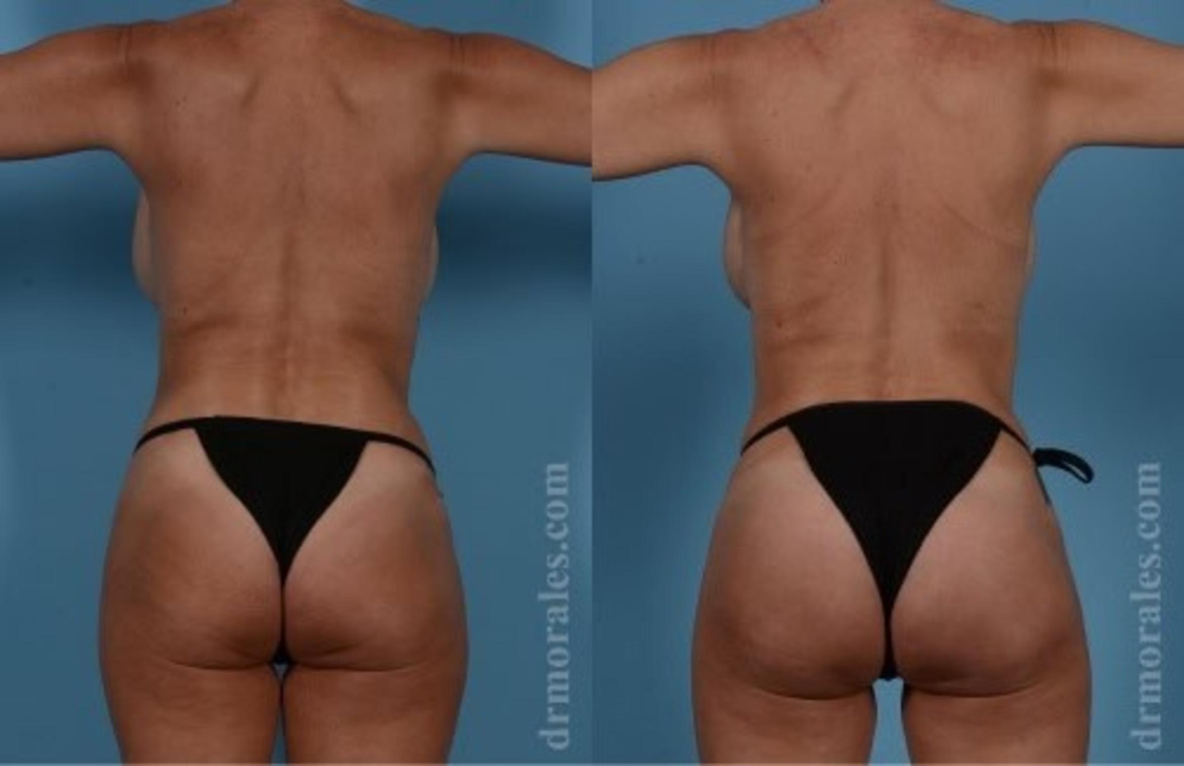 Before & After Fat Transfer Case 352 View 1 View in Houston, TX