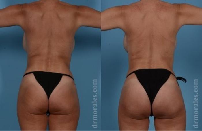 Before & After Fat Transfer Case 352 View 1 View in Houston, TX