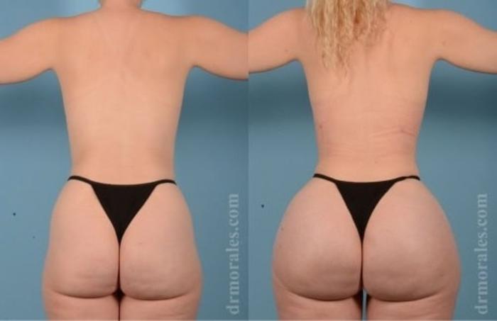 Before & After Fat Transfer Case 358 View 1 View in Houston, TX