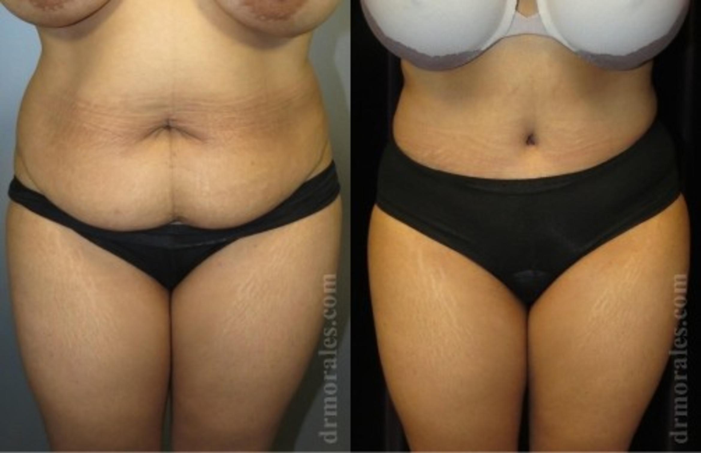 Before & After Fat Transfer Case 539 View 1 View in Houston, TX