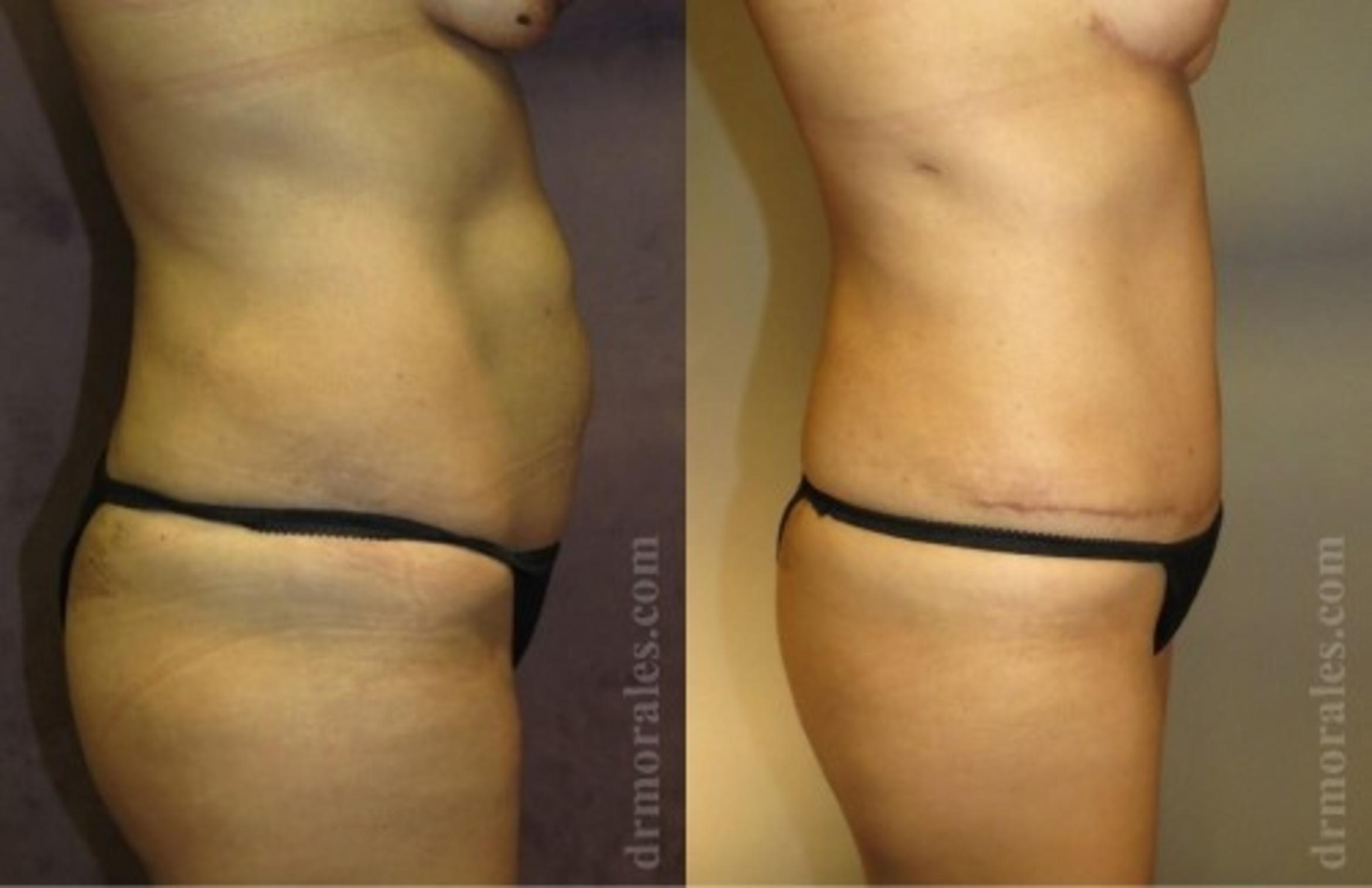 Before & After Liposuction Case 542 View 1 View in Houston, TX