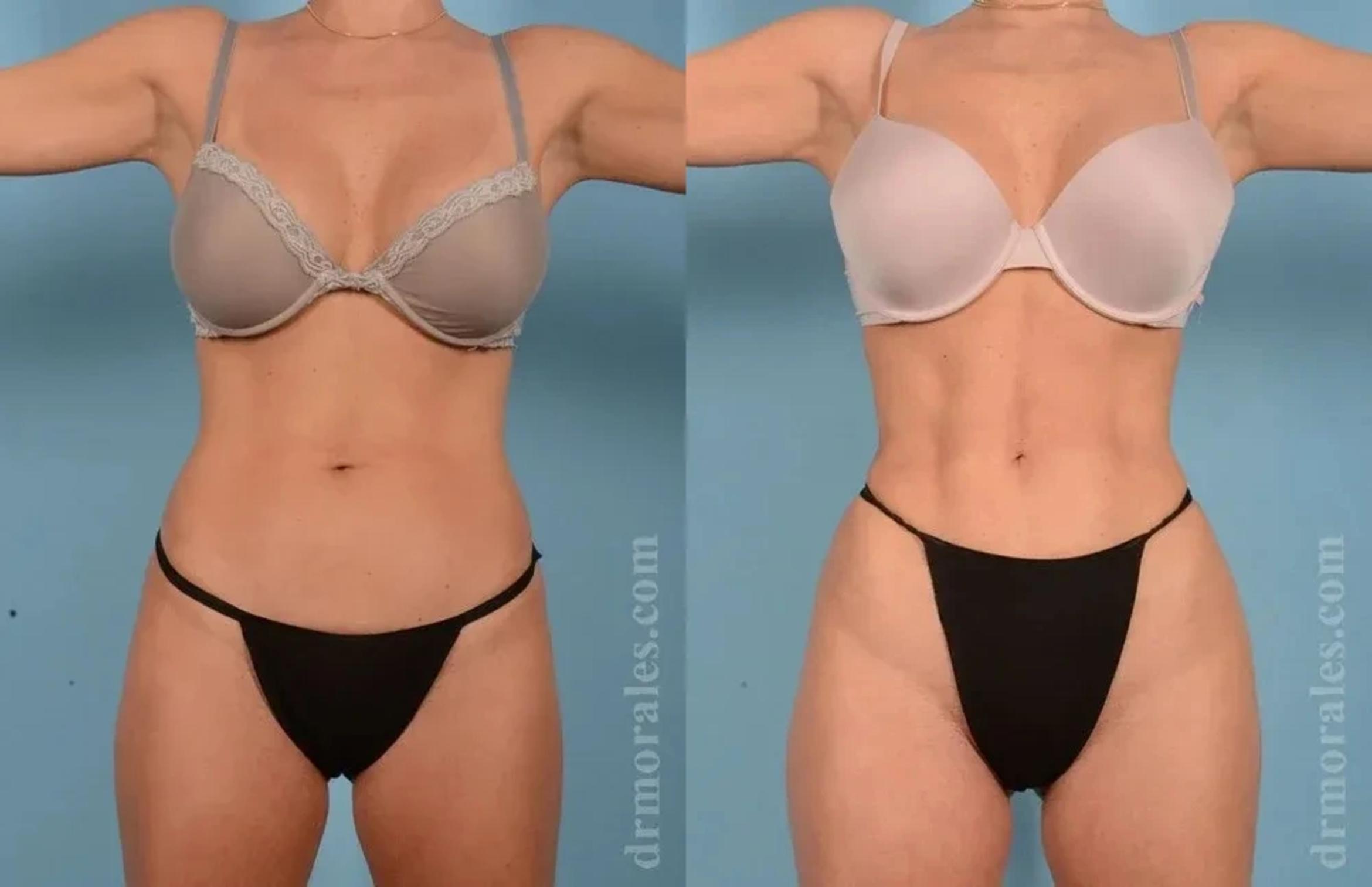 Before & After Female Abdominal Etching Case 182 View 1 View in Houston, TX