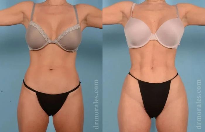 Before & After Female Abdominal Etching Case 182 View 1 View in Houston, TX