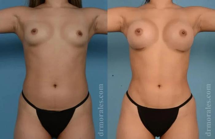 Before & After Female Abdominal Etching Case 183 View 1 View in Houston, TX
