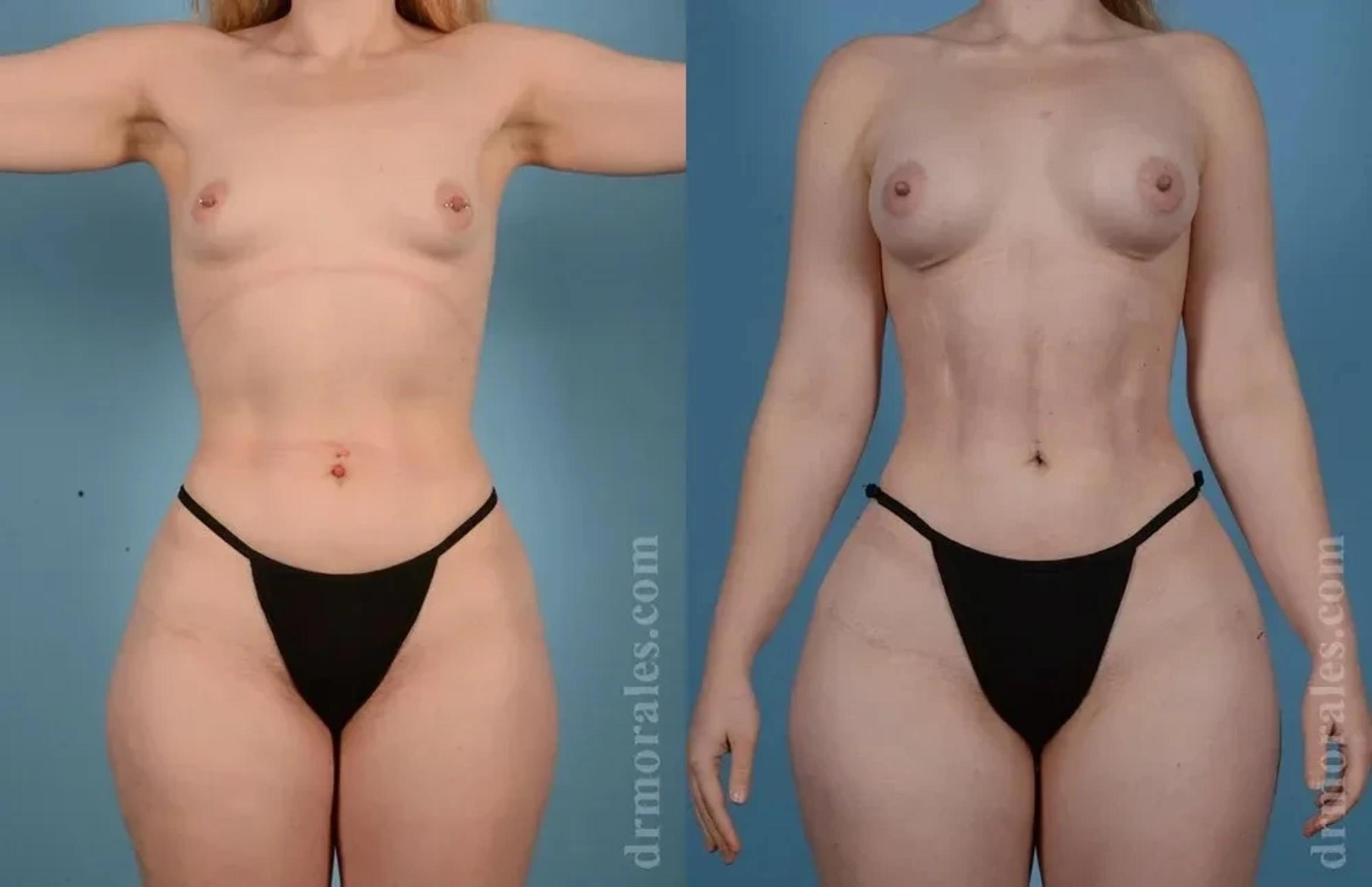 Before & After Female Abdominal Etching Case 185 View 1 View in Houston, TX