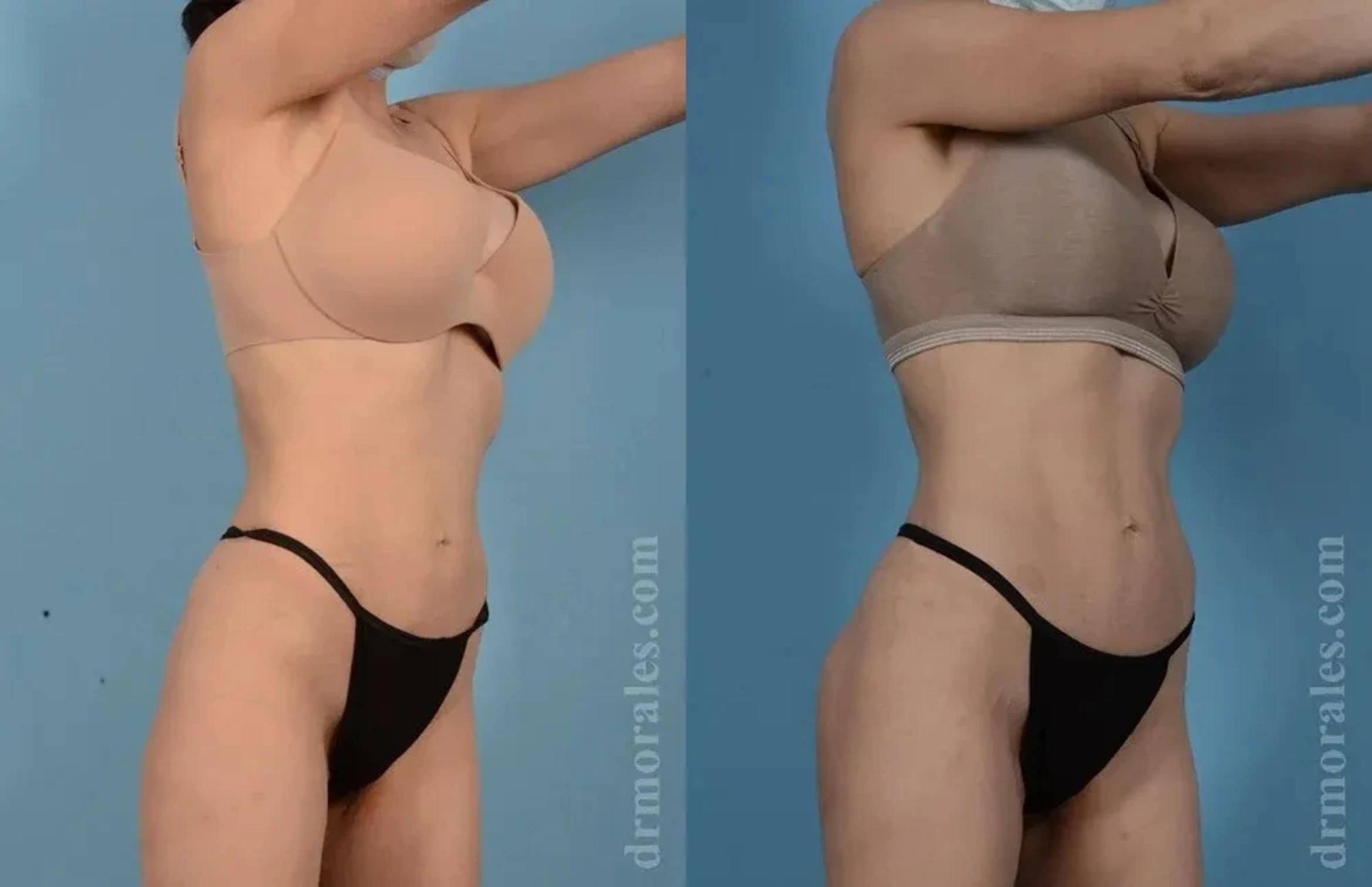 Before & After Female Abdominal Etching Case 186 View 1 View in Houston, TX