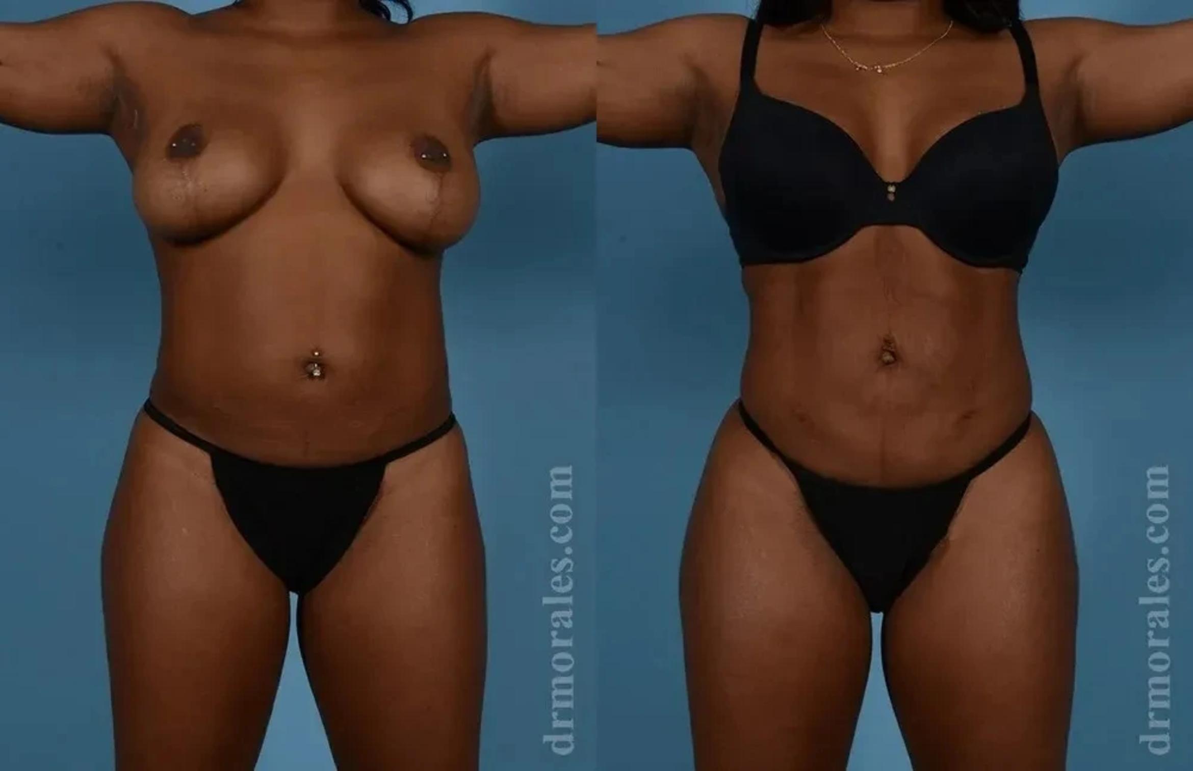 Before & After Female Abdominal Etching Case 187 View 1 View in Houston, TX