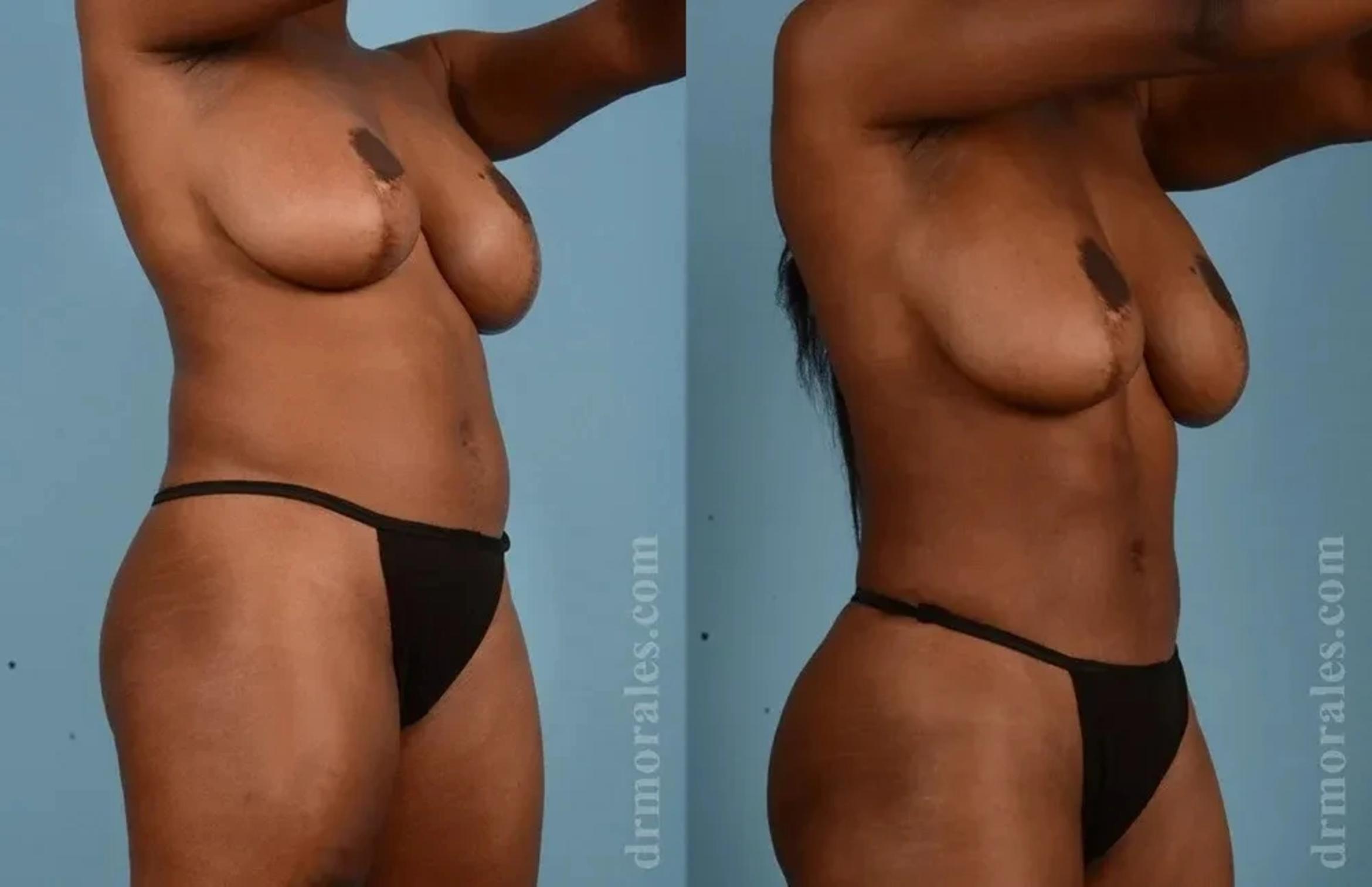 Before & After Female Abdominal Etching Case 189 View 1 View in Houston, TX