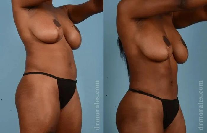 Before & After Female Abdominal Etching Case 189 View 1 View in Houston, TX