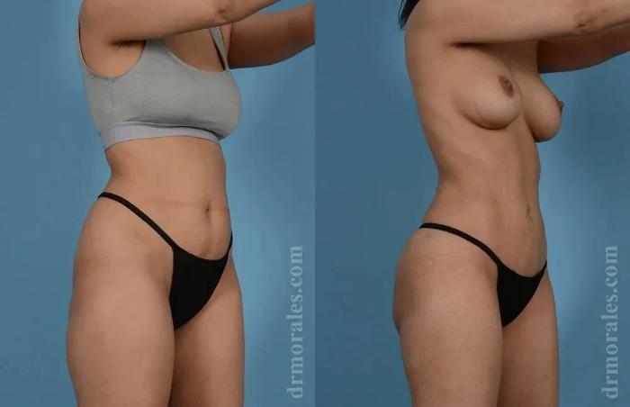 Before & After Female Abdominal Etching Case 190 View 1 View in Houston, TX