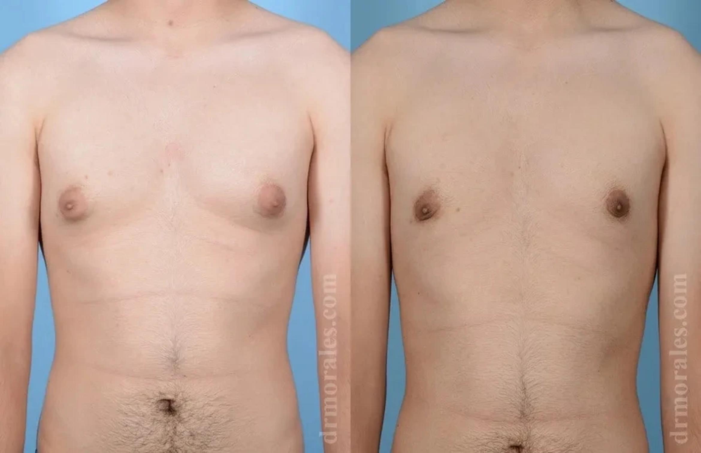 Before & After Gynecomastia Case 132 View 1 View in Houston, TX