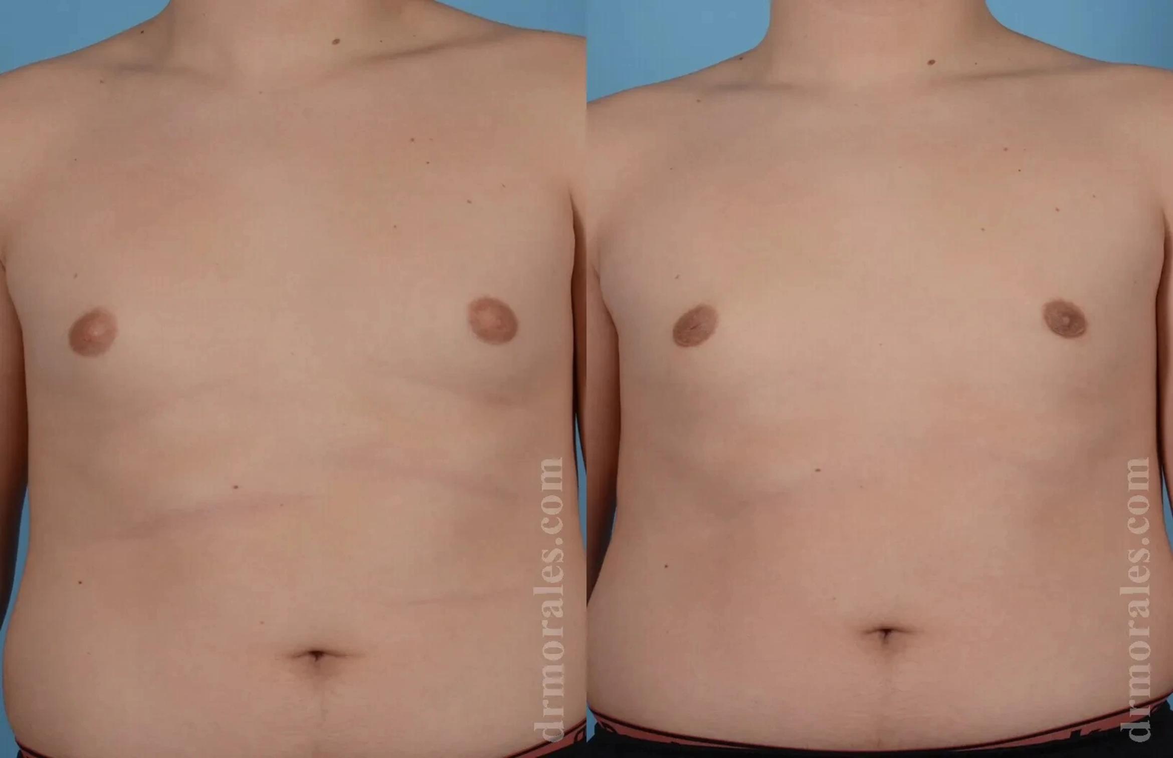 Before & After Gynecomastia Case 133 View 1 View in Houston, TX