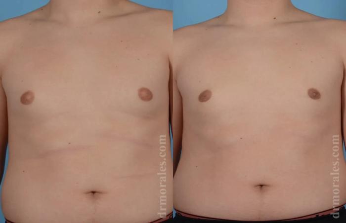 Before & After Gynecomastia Case 133 View 1 View in Houston, TX