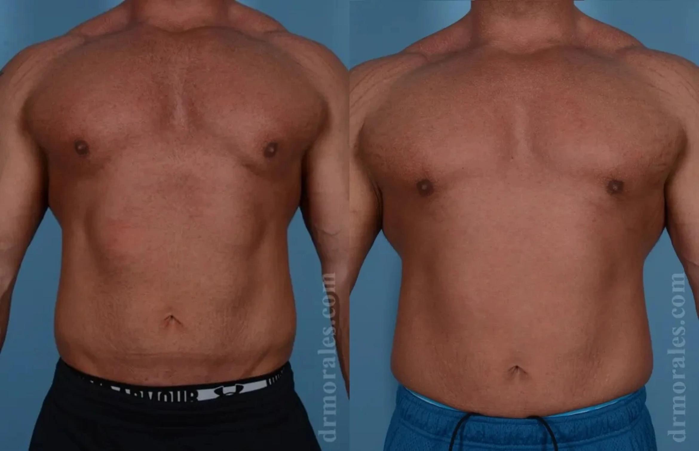 Before & After Gynecomastia Case 134 View 1 View in Houston, TX