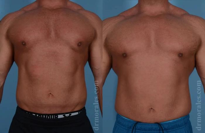 Before & After Gynecomastia Case 134 View 1 View in Houston, TX
