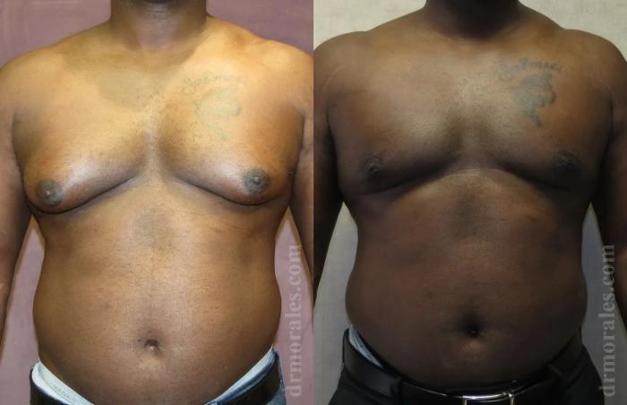 Before & After Gynecomastia Case 135 View 1 View in Houston, TX
