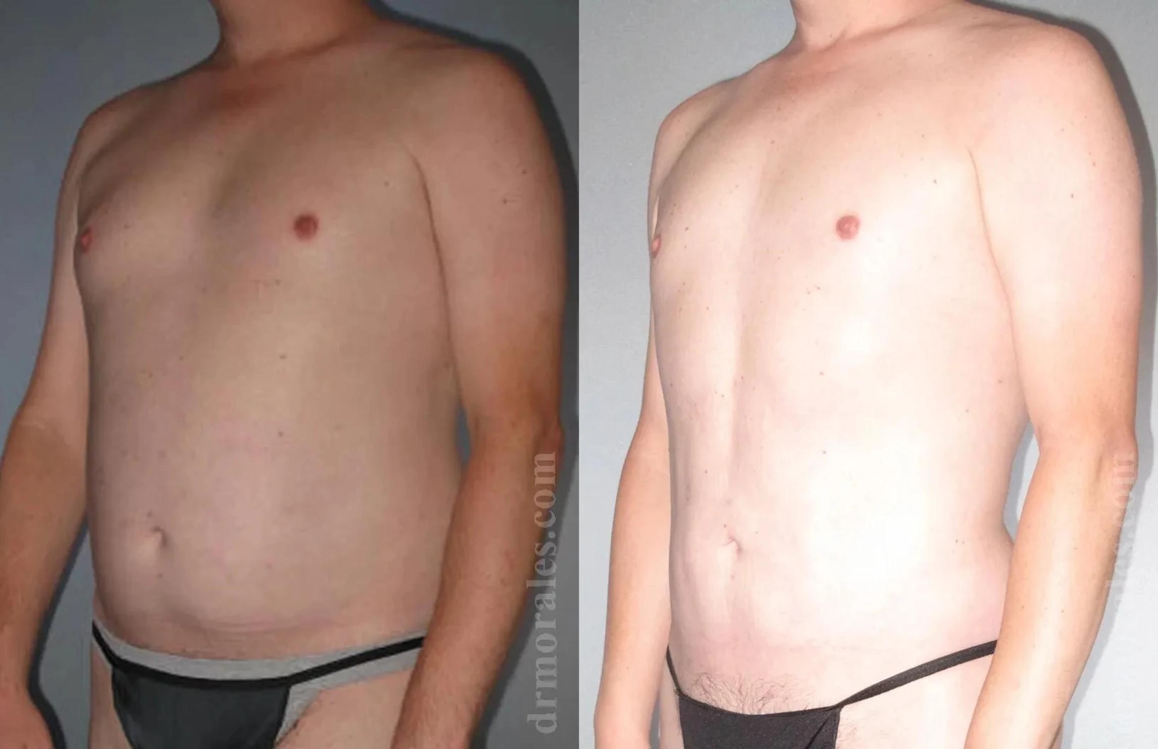 Before & After Gynecomastia Case 136 View 1 View in Houston, TX