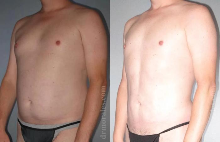 Before & After Gynecomastia Case 136 View 1 View in Houston, TX