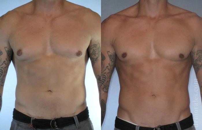 Before & After Gynecomastia Case 137 View 1 View in Houston, TX