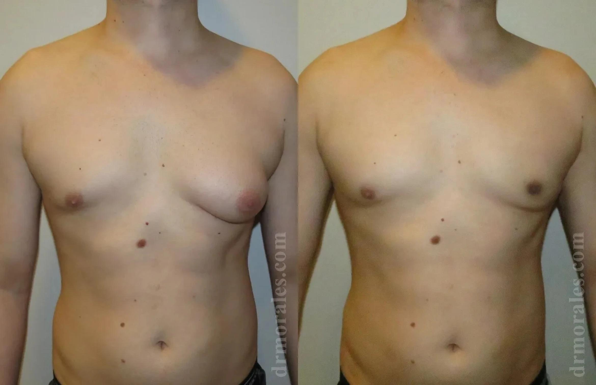 Before & After Gynecomastia Case 138 View 1 View in Houston, TX