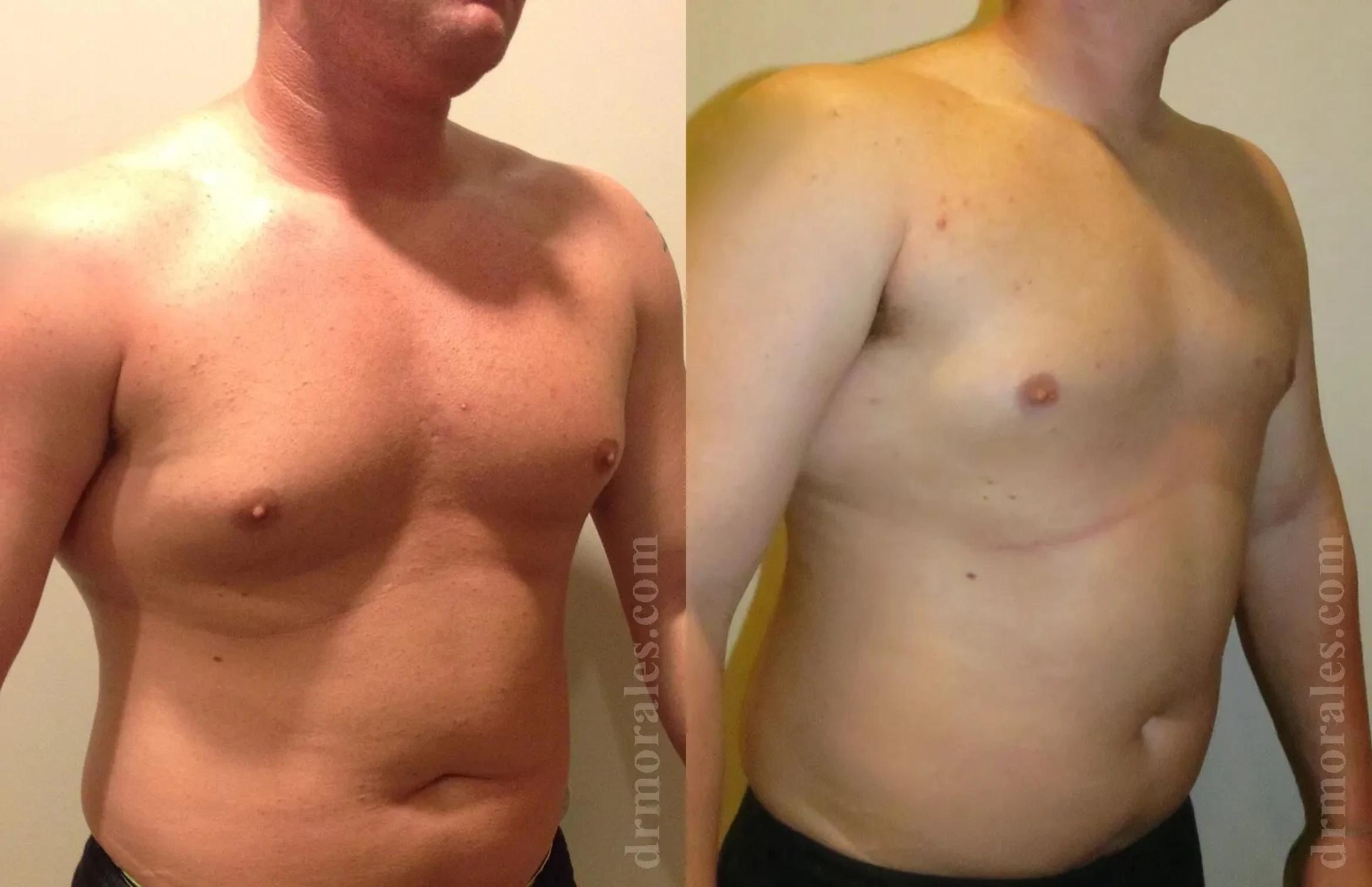 Before & After Gynecomastia Case 139 View 1 View in Houston, TX