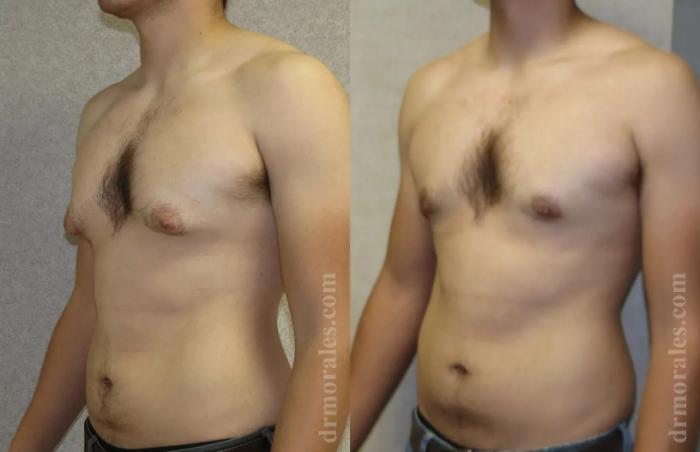 Before & After Gynecomastia Case 140 View 1 View in Houston, TX