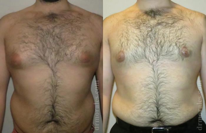 Before & After Gynecomastia Case 141 View 1 View in Houston, TX