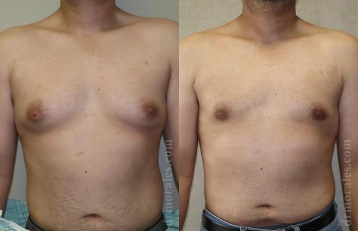 Before & After Gynecomastia Case 142 View 1 View in Houston, TX