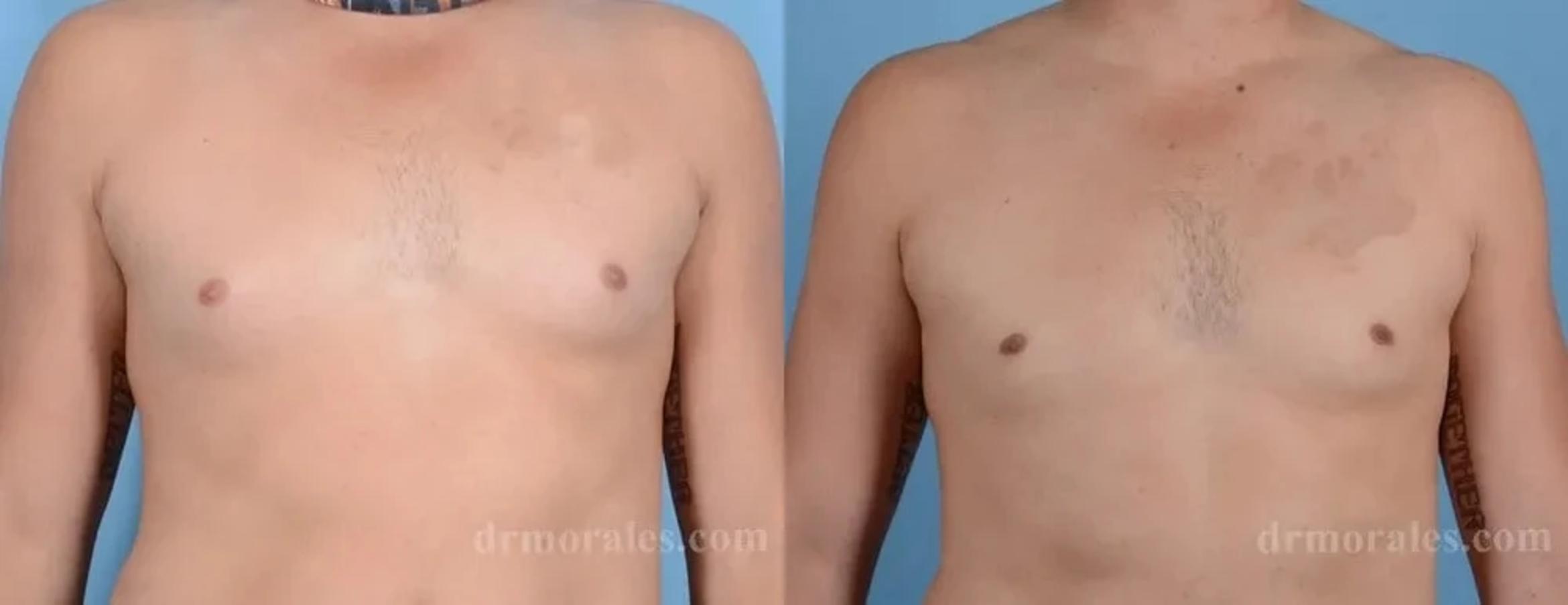 Before & After Gynecomastia Case 143 View 1 View in Houston, TX