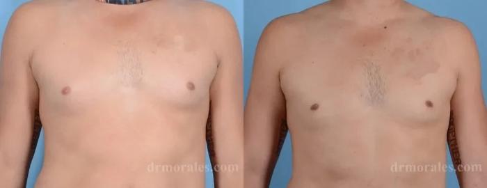 Before & After Gynecomastia Case 143 View 1 View in Houston, TX