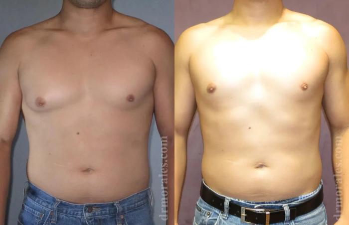 Before & After Gynecomastia Case 144 View 1 View in Houston, TX