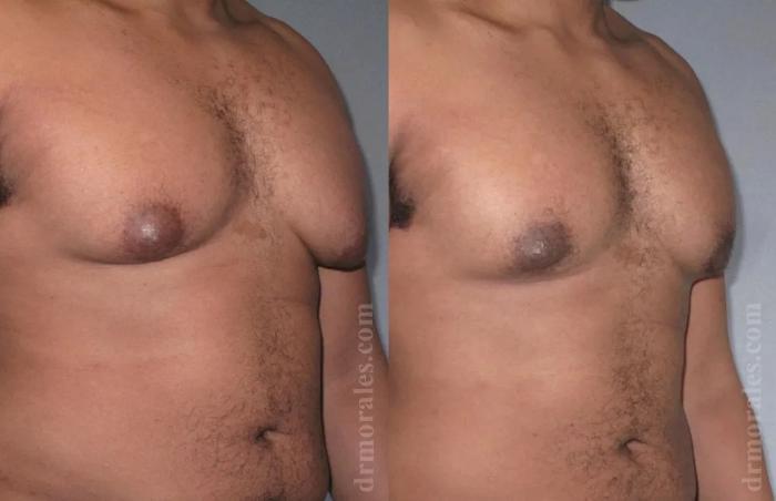 Before & After Gynecomastia Case 145 View 1 View in Houston, TX