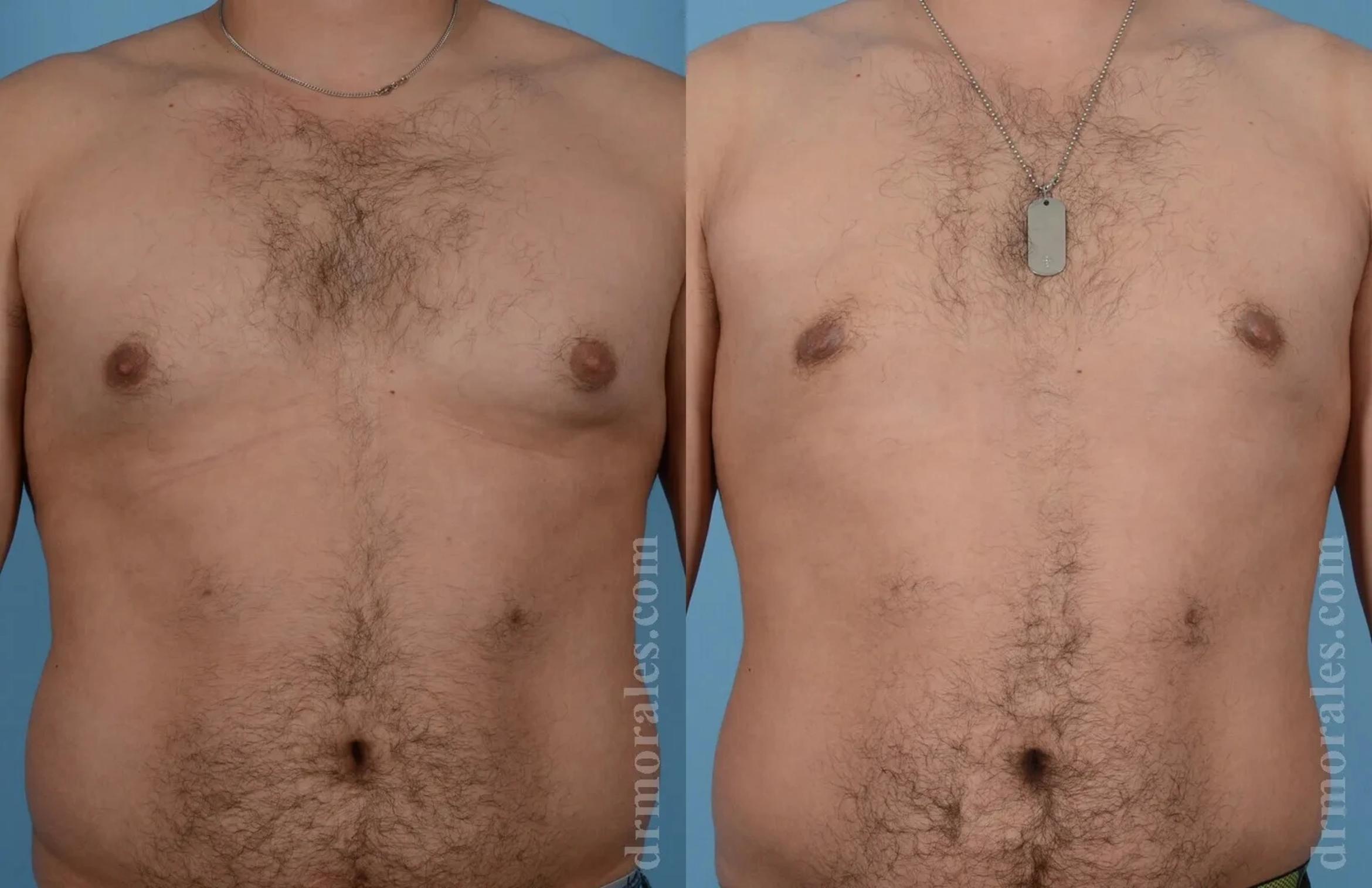 Before & After Gynecomastia Case 146 View 1 View in Houston, TX