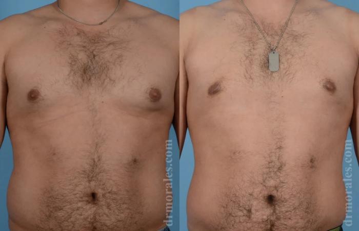 Before & After Gynecomastia Case 146 View 1 View in Houston, TX