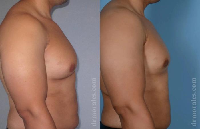 Before & After Gynecomastia Case 147 View 1 View in Houston, TX