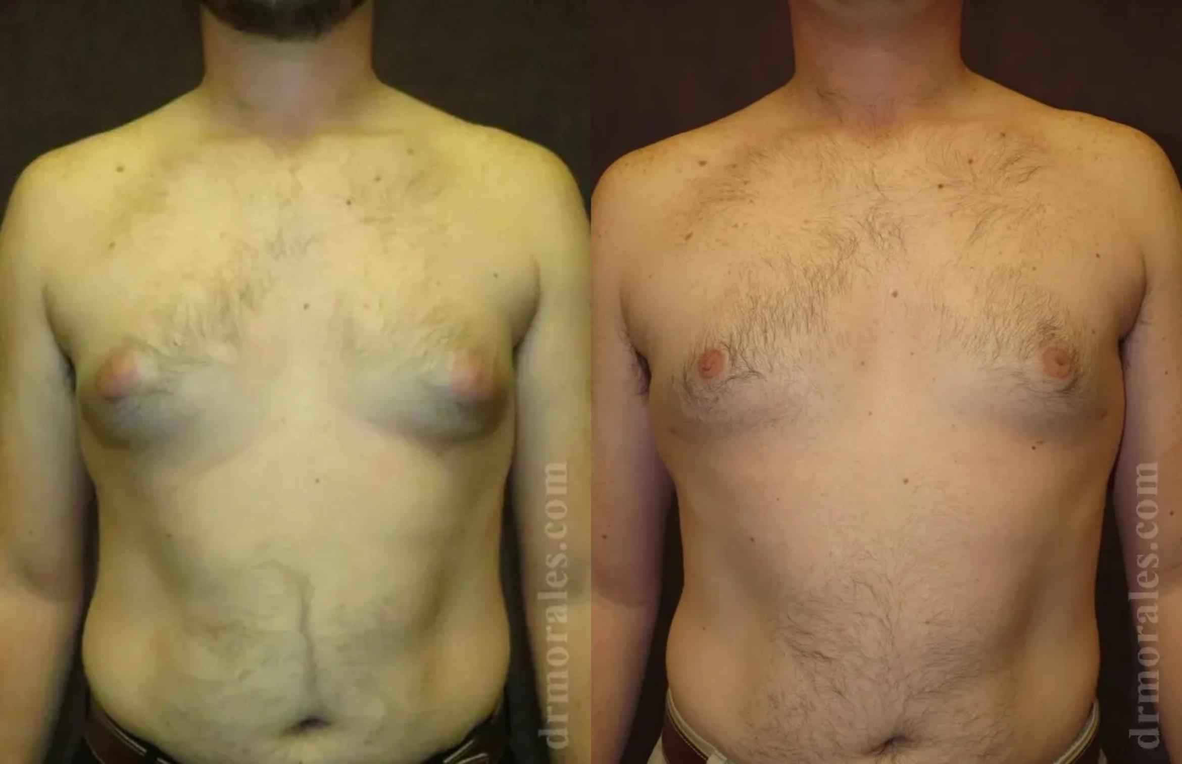 Before & After Gynecomastia Case 148 View 1 View in Houston, TX