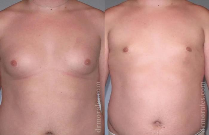 Before & After Gynecomastia Case 149 View 1 View in Houston, TX