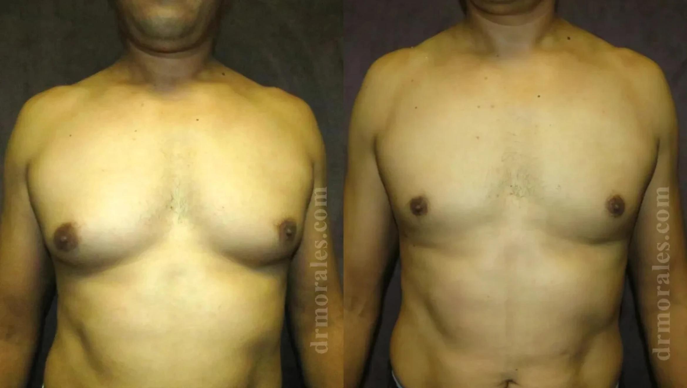 Before & After Gynecomastia Case 150 View 1 View in Houston, TX