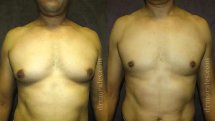 Before & After Gynecomastia Case 150 View 1 View in Houston, TX