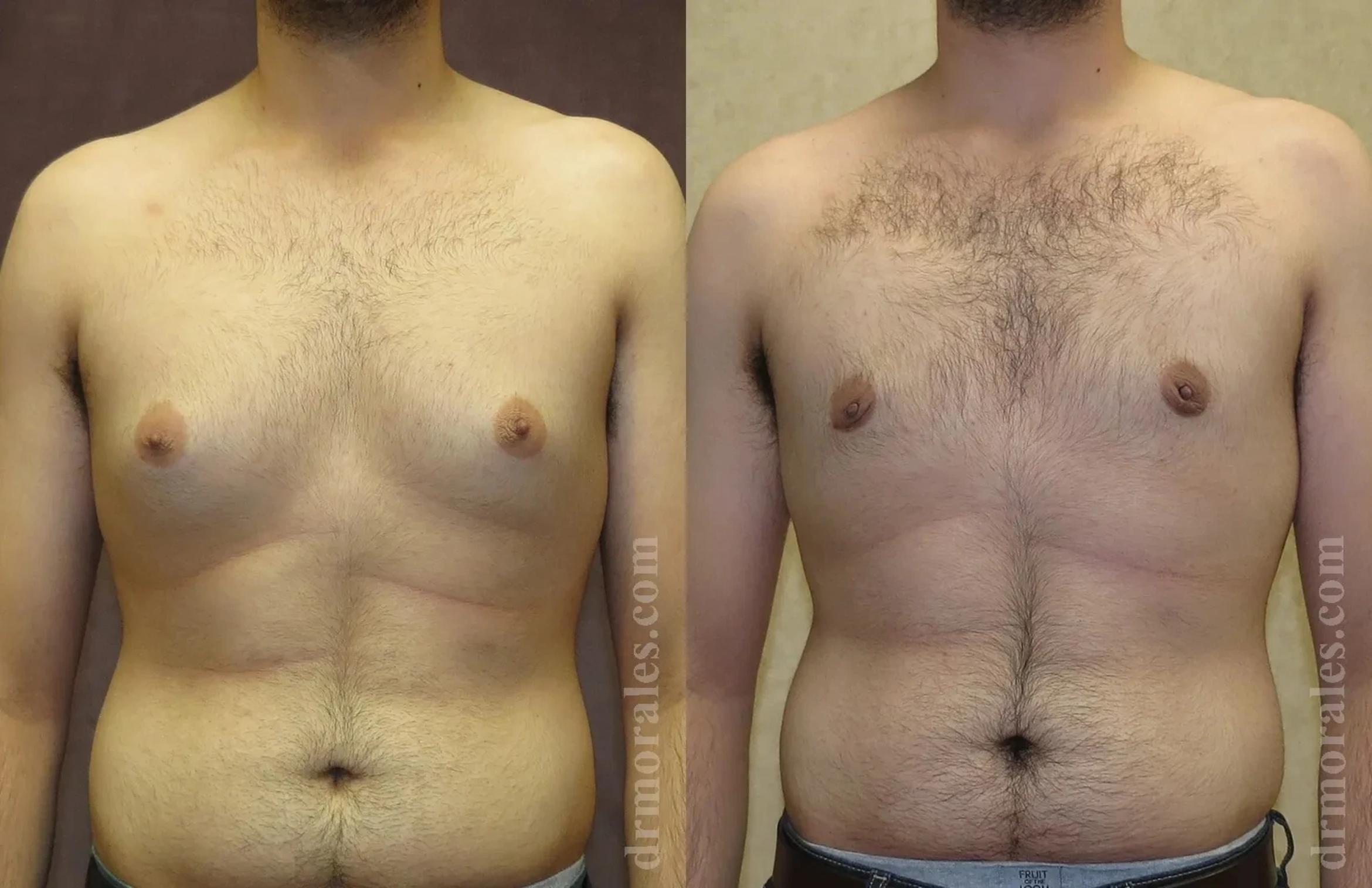Before & After Gynecomastia Case 151 View 1 View in Houston, TX