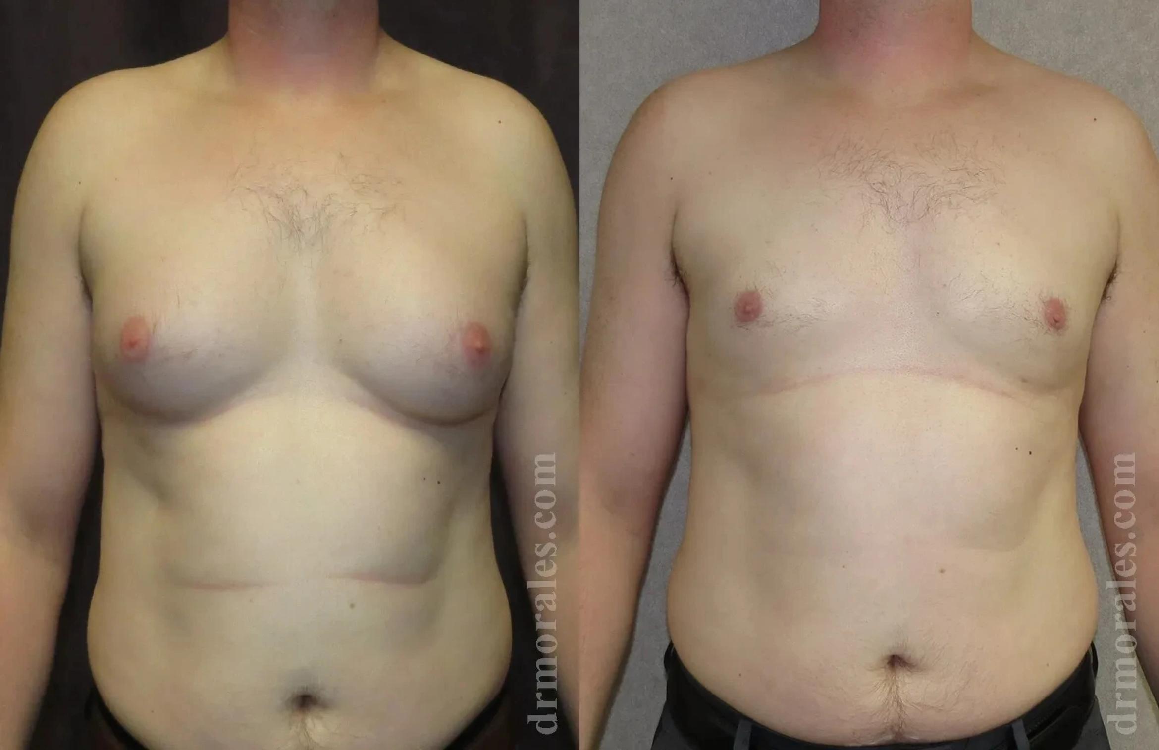 Before & After Gynecomastia Case 152 View 1 View in Houston, TX