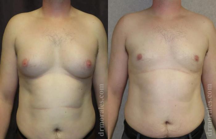 Before & After Gynecomastia Case 152 View 1 View in Houston, TX