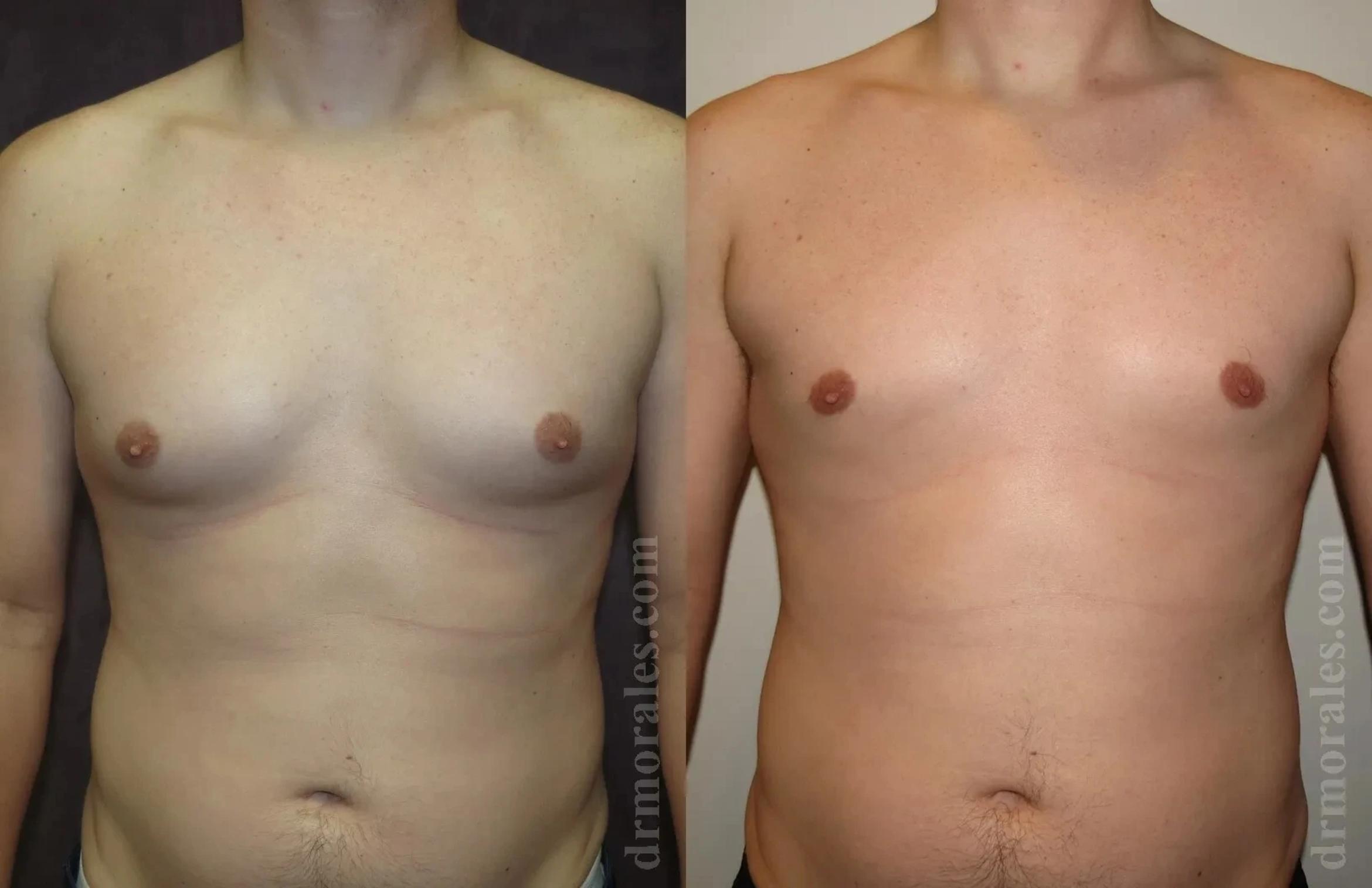 Before & After Gynecomastia Case 153 View 1 View in Houston, TX