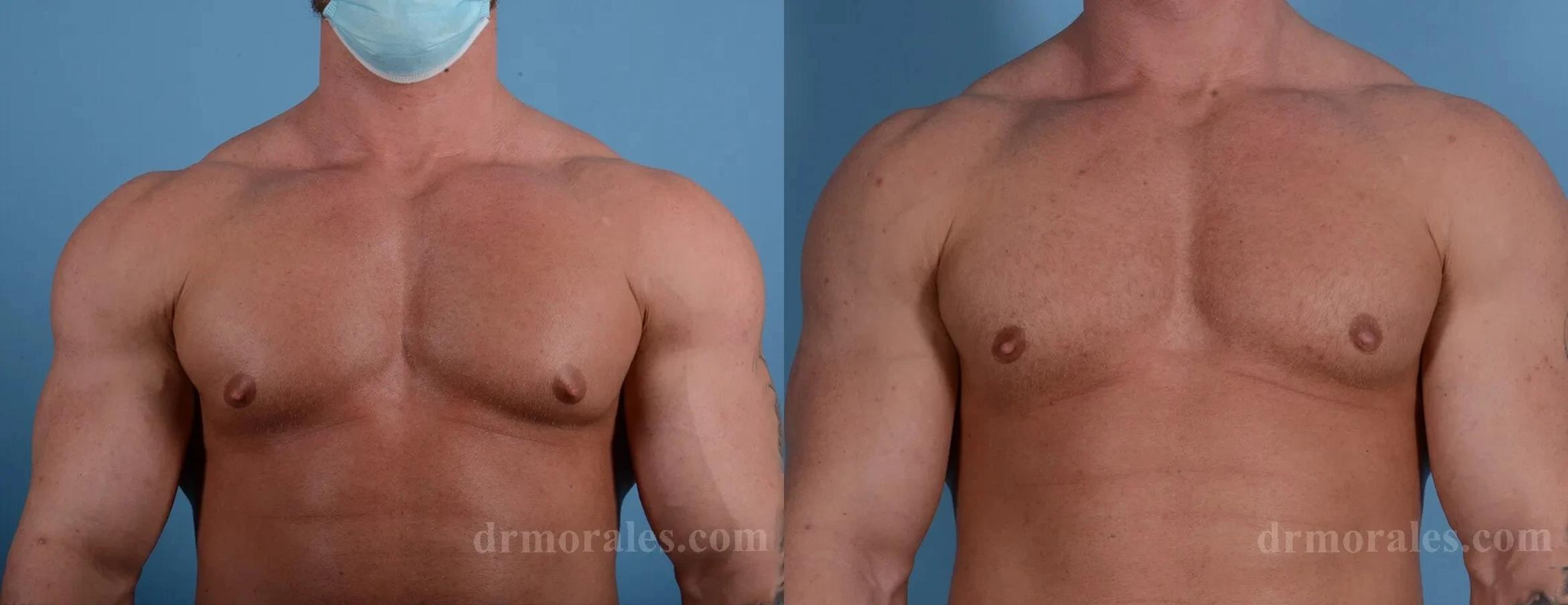 Before & After Gynecomastia Case 155 View 1 View in Houston, TX