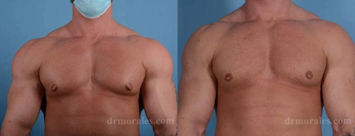Before & After Gynecomastia Case 155 View 1 View in Houston, TX