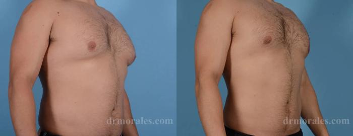 Before & After Gynecomastia Case 156 View 1 View in Houston, TX