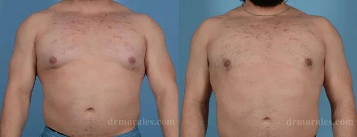 Before & After Gynecomastia Case 157 View 1 View in Houston, TX