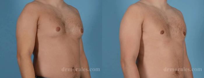 Before & After Gynecomastia Case 158 View 1 View in Houston, TX