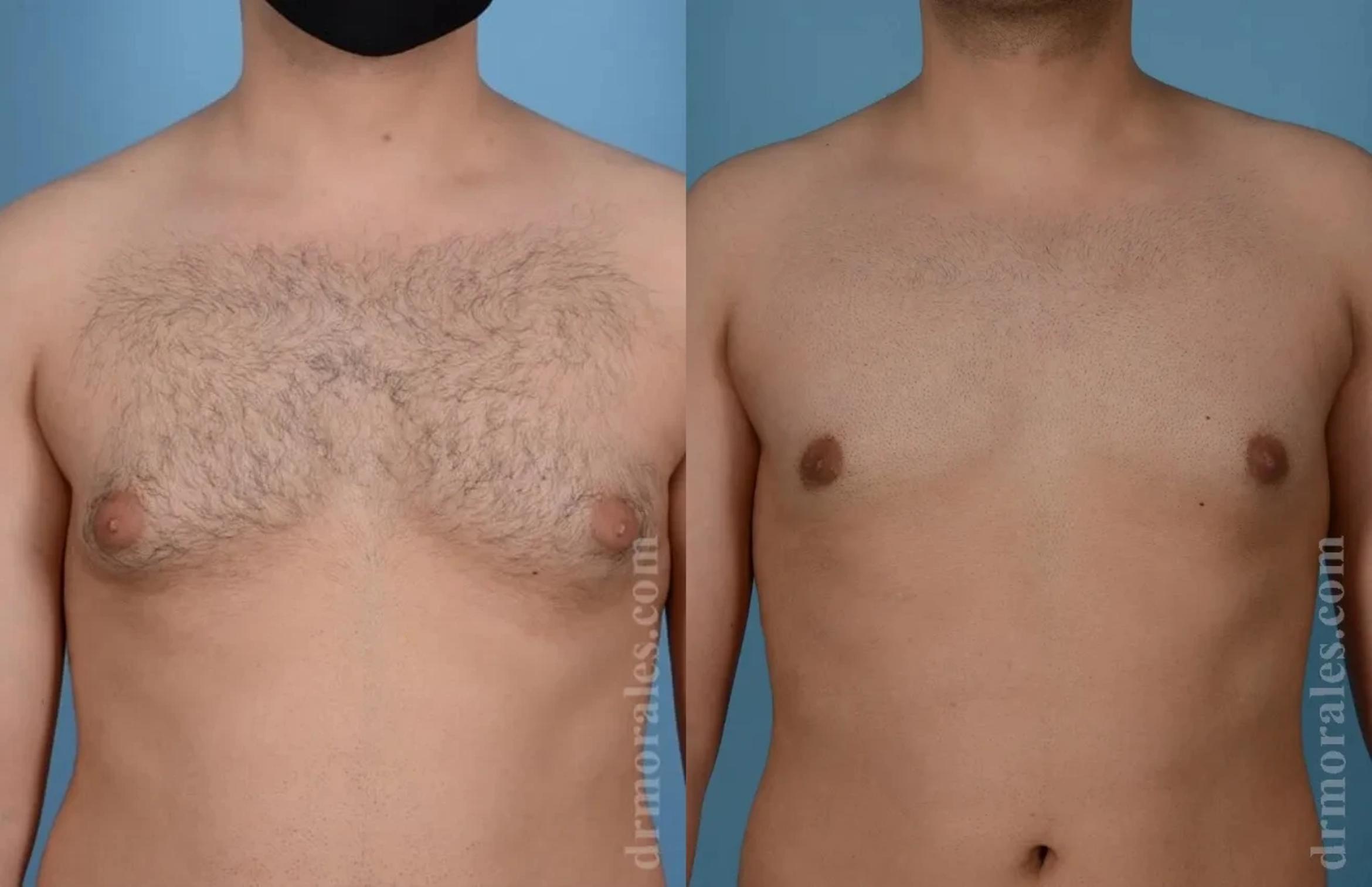 Before & After Gynecomastia Case 159 View 1 View in Houston, TX