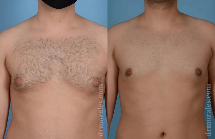Before & After Gynecomastia Case 159 View 1 View in Houston, TX